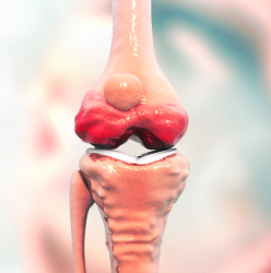 TRATAMENTO E PREVENÇÃO DA OSTEOARTITE